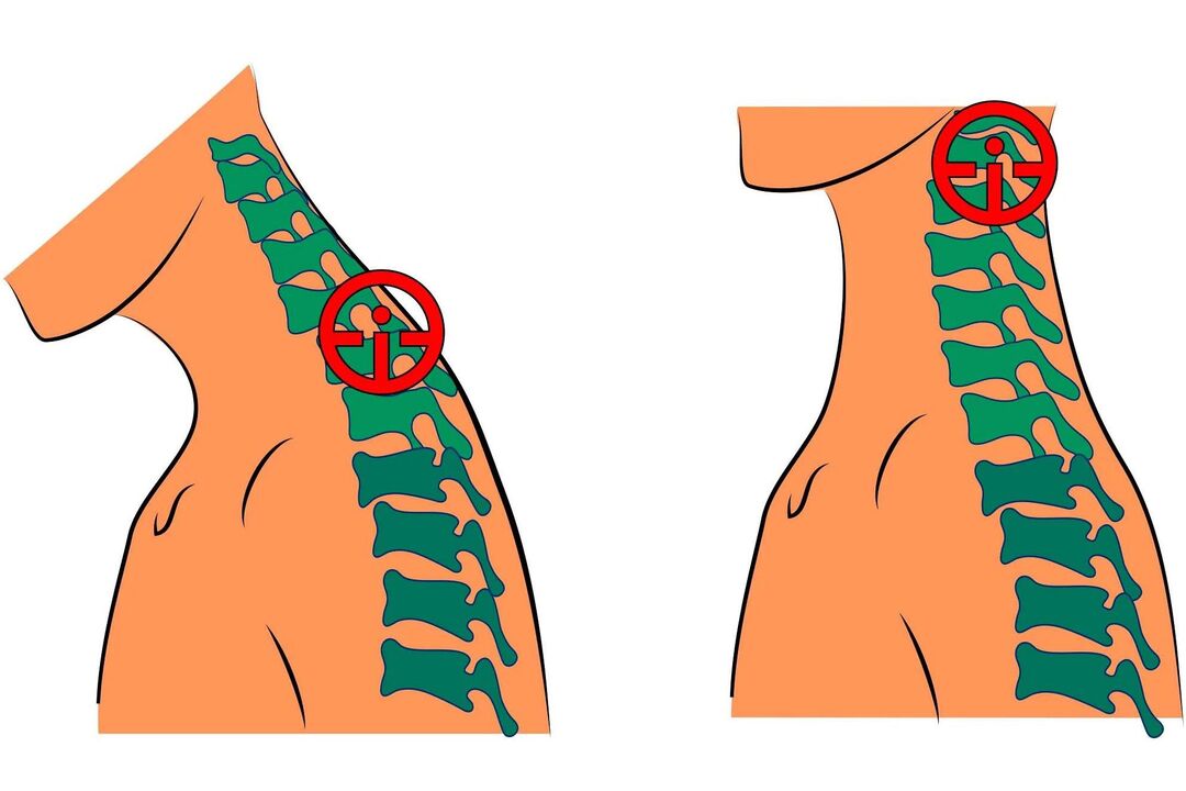 gimdos kaklelio osteochondrozė