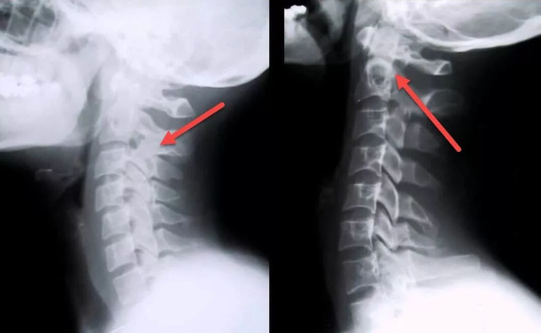 gimdos kaklelio osteochondrozės diagnozė