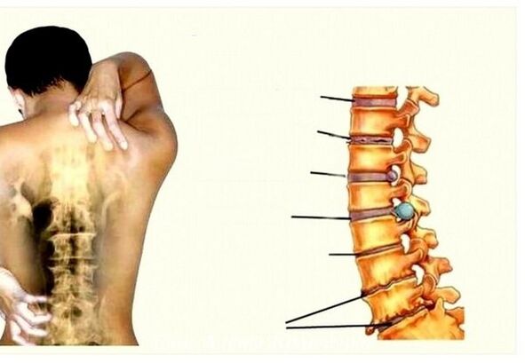 Gimdos kaklelio osteochondrozės etapai