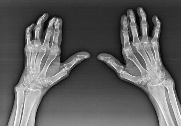 Pirštų sąnarių diagnostika