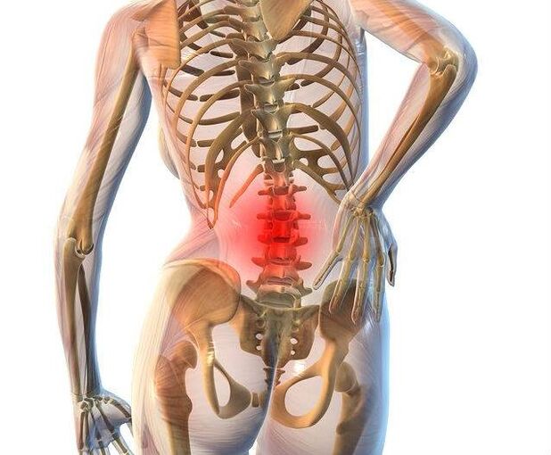 Juosmens stuburo osteochondrozė