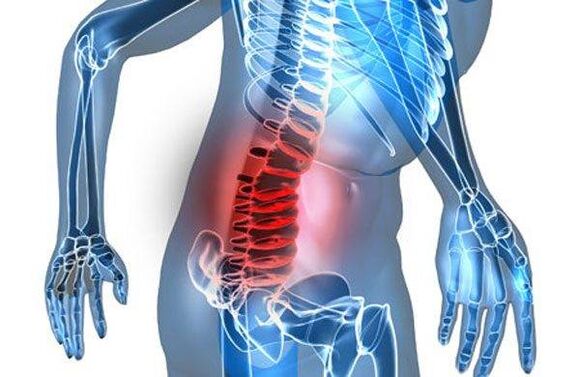 Stuburo deformacija juosmens osteochondrozės ketvirtoje stadijoje
