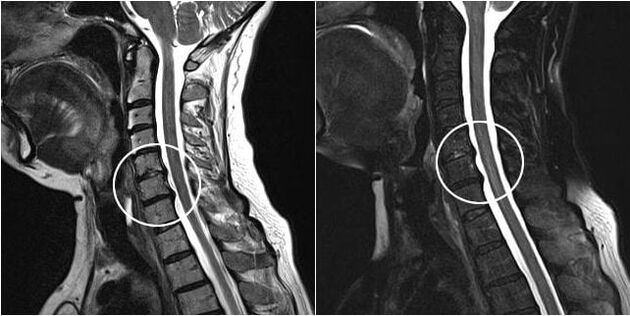 Kaklo stuburo MRT su osteochondrozės požymiais